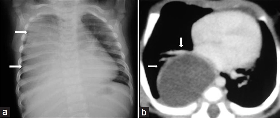 Esophageal duplication cyst in a 3-year-old girl with cough and dyspnea. (a) Chest radiograph shows homogenous opacification of the right hemithorax (arrows) at the time of first admission. (b) Follow-up CT scan 3 years later shows a large cystic periesophageal mass (arrows) . Diagnosis was confirmed at surgery.