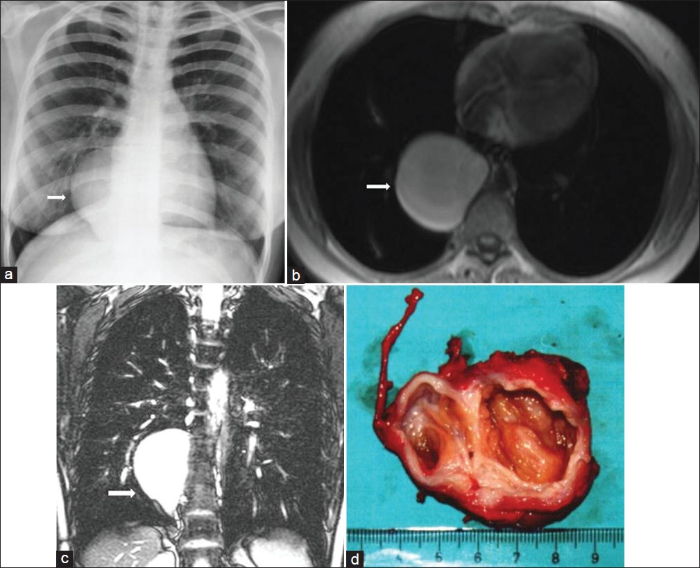 Neurenteric cyst in a 30-year-old female with flank pain. (a) Chest radiograph shows a well-defined round mass (arrow) in the lower thoracic region. (b- c) Both axial T1-weighted – and coronal T2-weighted MR images show a large mass that is of homogenous high signal intensity in the right paravertebral region (arrow). The cyst presumably contains proteinaceous fluid. (d) The photograph of the resected tumor shows a thick-walled encapsulated cystic mass.