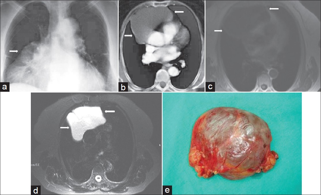 Pericardial cyst in a 40-year-old man with chest pain. (a) Chest radiograph shows a mass causing apparent enlargement of the right heart border. (arrow) (b) Contrast enhanced CT shows a well-circumscribed low-attenuation mass in the right cardiophrenic angle (arrows). (c) Axial T1-weighted MR image shows a round low-signal intensity lesion (arrows) in the right cardiophrenic angle. (d) T2-weighted fat- supressed MR image shows that the lesion (arrows) is of similar signal intensity as that of CSF, which suggests a cyst. (e) Photograph shows a cystic mass.