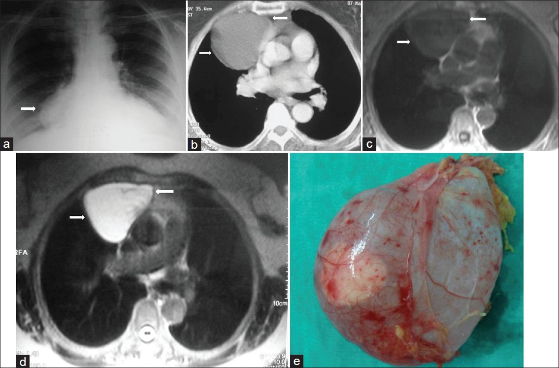 Pericardial diverticulum in an asymptomatic 45-year-old man. (a) Chest radiograph shows a mass (arrow) with smooth contour in the right cardiophrenic angle (arrow). (b) Contrast enhanced CT shows a low-attenuation mass (arrows) in the right cardiophrenic angle. (c) The mass (arrows) shows homogeneously low signal intensity on axial T1-weighted MR image and (d) high signal intensity (arrows) on T2-weighted MR image. (e) Photograph shows a translusent round cyst.