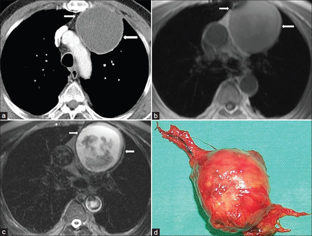 Thymic cyst in a 60-year-old asymptomatic male with a history of coronary artery by-pass surgery. (a) Contrast enhanced CT shows inhomogenous unilocular low-attenuation mass (arrows) in the anterior mediastinum, (b) Axial T1-weighted MR image shows a well-circumscribed mass with heterogenous signal intensity in the anterior mediastinum (arrows). (c) Axial T2-weighted MR image shows a high signal intensity unilocular cystic mass (arrows). There are some areas of low signal intensity corresponding to the small debris materials. Needle biopsy was performed. Microscopic examination revealed a thymic cyst containing cellular keratinous material. (d) Specimen shows a cystic mass.