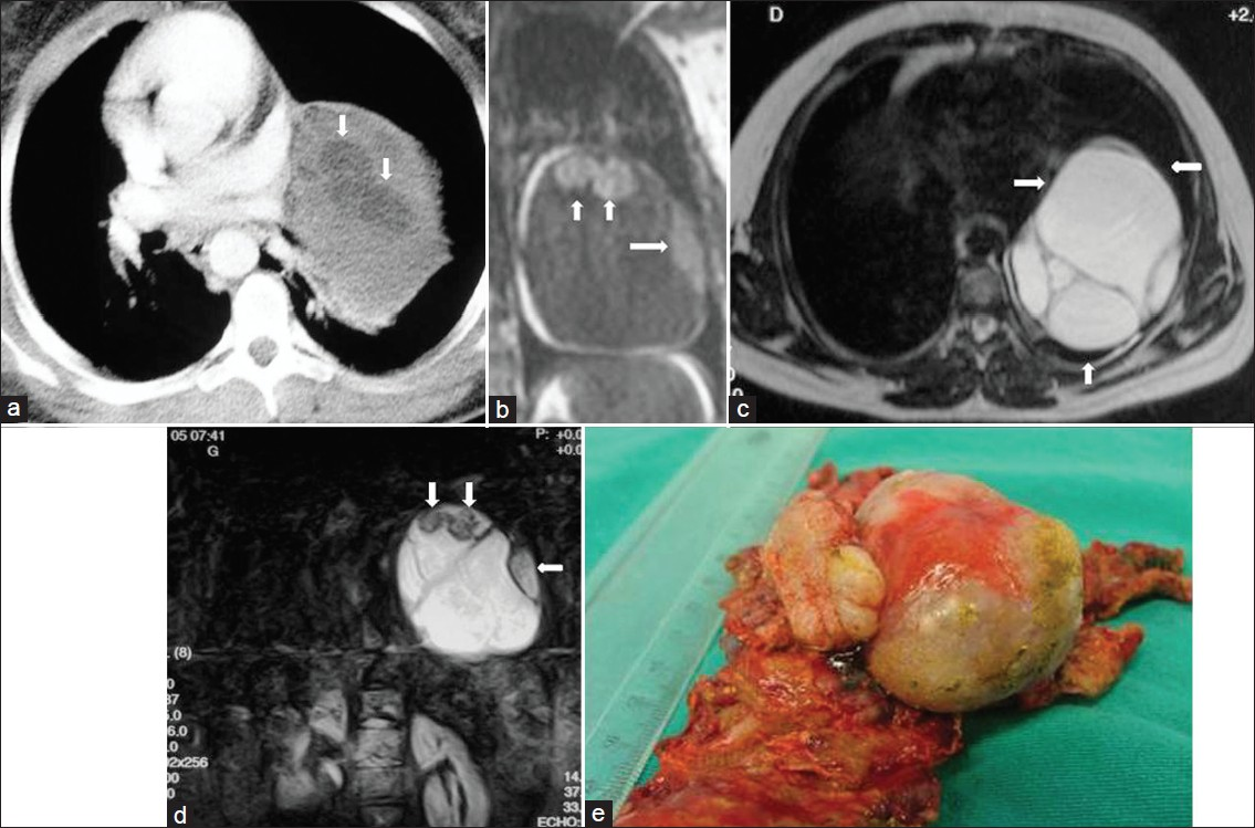 Mature cystic teratoma in a 20-year-old female who had chest pain and dyspnea. (a) Contrast enhanced CT shows a heterogeneous mediastinal mass with fat-containing areas (arrows). (b) Coronal T1-weighed MR image shows a mass with low signal intensity and areas of fat with high signal intensity (arrows). (c) On T2-weighted MR image, the mass shows a multilocular appearance with high signal intensity (arrows). (d) T2-weighted fat-suppressed MR image shows that the mass contains a high signal intensity of multilocular cystic mass and nodular areas with low signal intensity (arrows). (e) Photograph of the specimen.