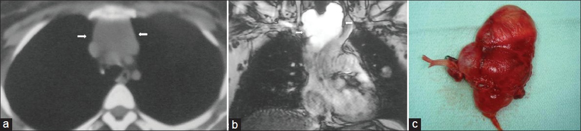 Lymphangioma in an asymptomatic 30-year-old female. (a) Contrast enhanced CT shows a low- attenuation mass (arrows). (b) Coronal T2-weighted MR image shows a high signal intesity cystic mass (arrows) in the upper mediastinum. (c) Photograph of the cystic lesion.