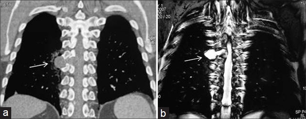 Cystic schwannoma in a 30-year-old asymptomatic female. (a) Reformatted coronal CT shows a homogenous low-attenuation mass in the paravertebral gutter (arrow). An extension into the neural foramen is suspected suggesting a neural tumor. (b) Coronal T2-weighted MR image shows a homogenous high signal intensity cystic lesion (arrow) that is an extension into the neural foramen. Diagnosis was confirmed at surgery.