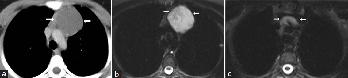 Recurrent cystic thymoma in a 14-year-old girl with a history of multiple resection of cystic thymic lesion. (a) Contrast enhanced CT shows a low-attenuation lesion (arrow) in the anterior mediastinum at the first admission. (b) Axial T2-weighted MR image shows a thin -walled high signal intensity cystic lesion (arrow). (c) Post surgical (4 years after surgical operation of the cystic lesion) T2-weighted MR image at the same level shows a lobulated mass (arrow) with cystic components.