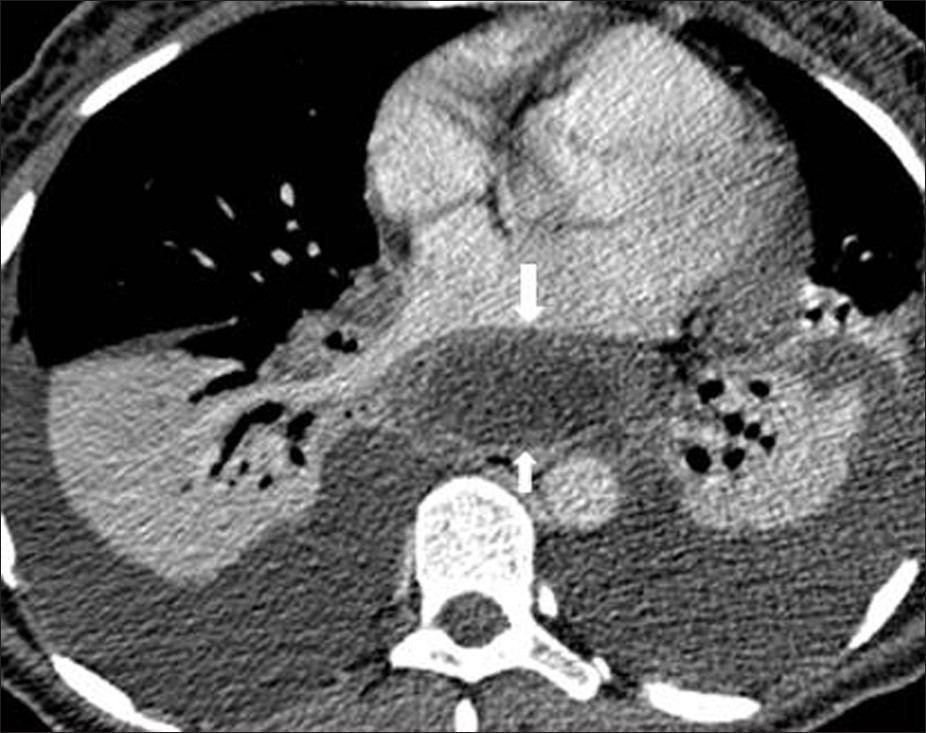 Pancreatic pseudocyst in a 40-year- old male with a 3-week history of chest-and epigastric pain. Contrast enhanced CT shows bilateral pleural effusion and periaortic fluid collection(arrow) displacing the esophagus (arrow) (This case courtesy of Aysel Türkvatan, Ankara, Turkey).