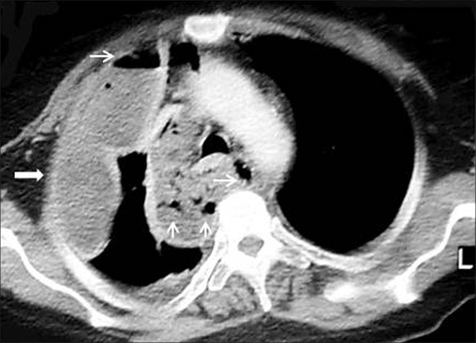 Mediastinal abscess in a 40-year-old male who had blunt trauma. Contrast enhanced CT shows a low- attenuation mass (arrow) with gas bubble (thin arrow) and loculated pleural effusion on the right.