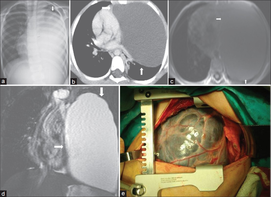 Mediastinal angiomatosis in a 7-year-old boy with chest pain. (a) On chest radiograph, the left hemitorax is diffusely opacified (arrow). (b) Contrast enhanced CT shows a huge mass (arrow) with uniform low-attenuation of the left hemithorax with mass effect on the mediastinum. (c) Axial T1-weighted MR image shows a large low signal intensity cyst (arrow). (d) Coronal T2-weighted MR image shows that the large mass (arrow) is of homogenous high signal intensity without septation. (e) Photograph of the mass.