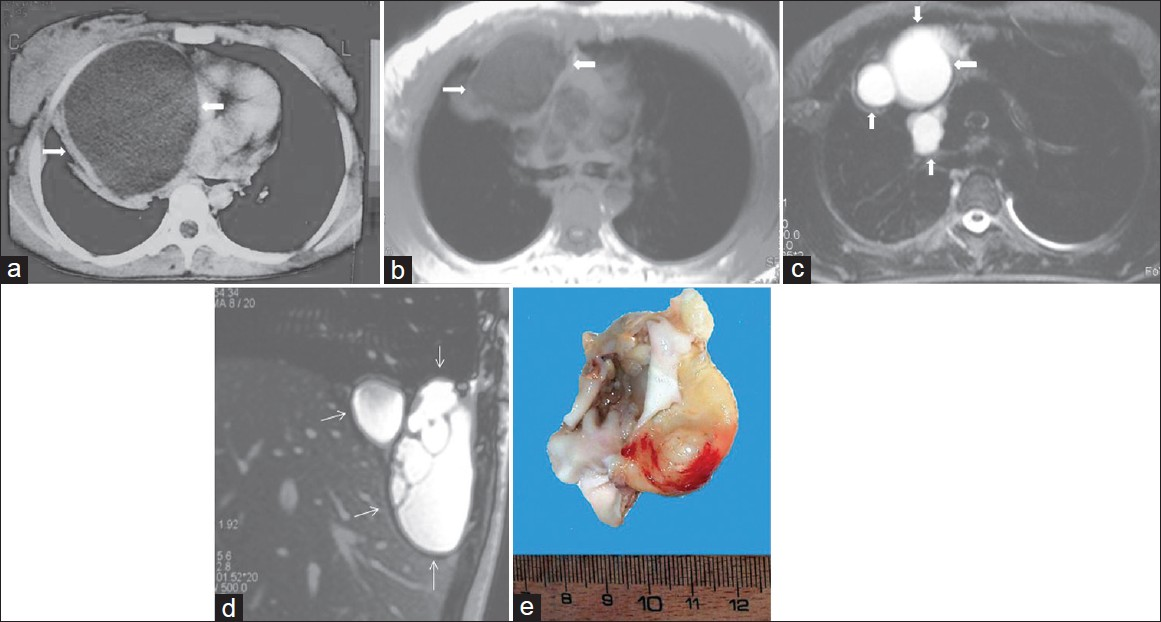 Mediastinal unilocular hydatid cyst in a 28-year-old female with chest pain and dyspnea. (a) Contrast enhanced CT at the first admission (4 years prior to he current admission) shows a large low-attenuation mass (arrow) with smooth contour and round shape and thick wall in the mediastinum. Note also the displacement of the heart to the left.Four years later percutaneous aspiration under CT guidance, (b) Axial T1-weighted- (arrow) and (c-d) Axial and sagittal T2-weighted MR images show the hydatid localizations involving the mediastinum (arrow) and pleural space (thin arrow) .The signal intensity of the lesions is homogenous low signal intensity on T1-weighted images, and of high signal intensity on T2- weighted images. MR images reveal that the cystic lesions were implanted both in the mediastinum and pleural space. (e) Photograph of the specimen.