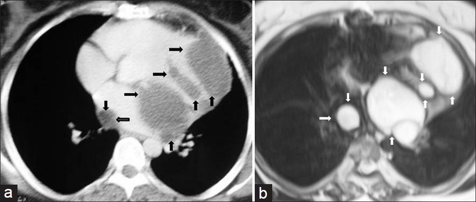 Mediastinal multilocular hydatid cyst in a 50-year-old female with severe chest pain. (a) Contrast enhanced CT shows multiple low-attenuation lesions (arrow) in the mediastinum. (b) T2-weighted MR image shows multilocular cystic lesions (arrows) with a thin wall and with high signal intensity contents. At surgery, mediastinal hydatid cysts were removed.