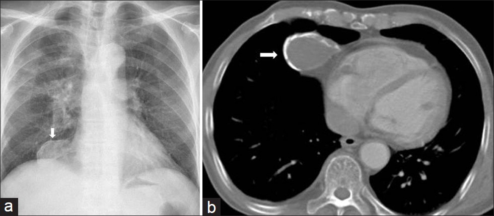 Mediastinal calcified hydatid cyst in a 30-year-old man (a) Chest radiograph shows a well defined opacity in the right cardiophrenic angle (arrow). (b) Contrast enhanced CT shows a cystic lesion with segmental ring formed calcification that connects to the pericardium (arrow). At surgery calcified hydatid cyst was removed.