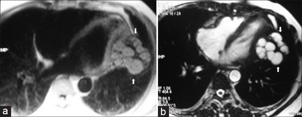 Pericardial hydatid cyst in a 45-year old female with chest pain and arytmia. (a) Turbo FLASH sequence-proton density weighted axial image shows multiple hyperintense daughter cysts with low signal intensity capsule in the pericardium (arrows). (b) On turbo FLASH sequence-T2 weighted image, multiple daughter cysts demonstrate high - and homogenous signal intensity and low signal intensity rim and capsule (arrows). At surgery, hydatid cystic lesions were removed (reprinted with permission from 29).