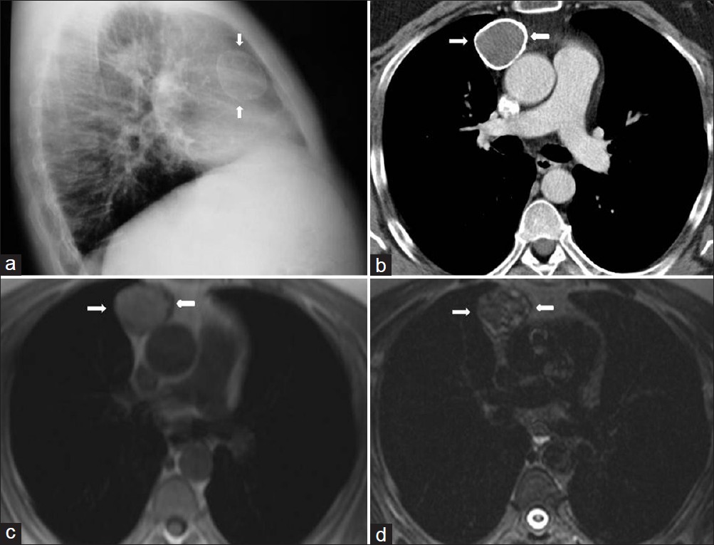 Chronic hematoma in a 40-year-old man with a chest trauma history. (a) Lateral chest radiograph shows a dense spherical mass in the anterior mediastinum (arrows) (b) Contrast enhanced CT shows a well-defined mass (arrows) with a calcified thick wall originating from the anterior mediastinum. (c) The signal intensity of the mass is of intermediate to moderate high signal intensity (arrows) on T1-weighted images,and (d) of heterogenous signal intensity on T2-weighted images (arrows). Diagnosis was confirmed at surgery.