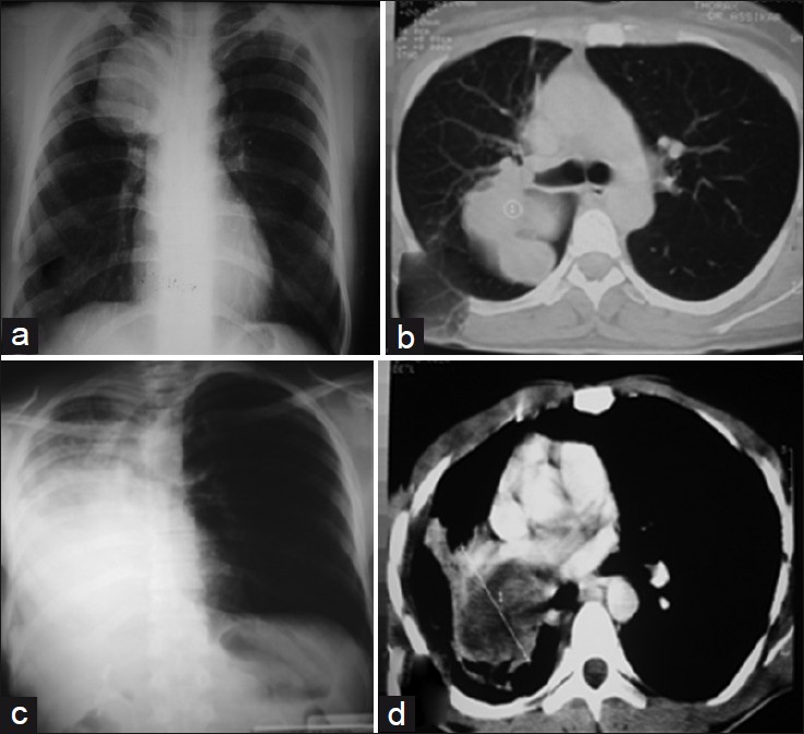 Case 1, a 45-year-old woman: (a) Anterior chest radiograph shows a round opacity on the upper zone of right lung. (b) Computed tomography of thorax reveals a round tissular lesion of dorsal segment of right upper lobe, obstructing the right lobar bronchus.Case 2, a 30-year-old man: (c) Anterior chest radiograph shows an almost total opacification of the right lung with a mediastinal shift to the same side. (d) Computed tomography of thorax reveals an endobronchial tumor in the right main bronchus, causing complete atelectasis in the right middle lobe.