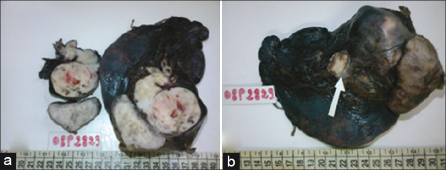 Case 1: (a) Grossly, the tumor shows a fleshy white lesion with necrosis, hemorrhage and (b) an intraluminal polyp.