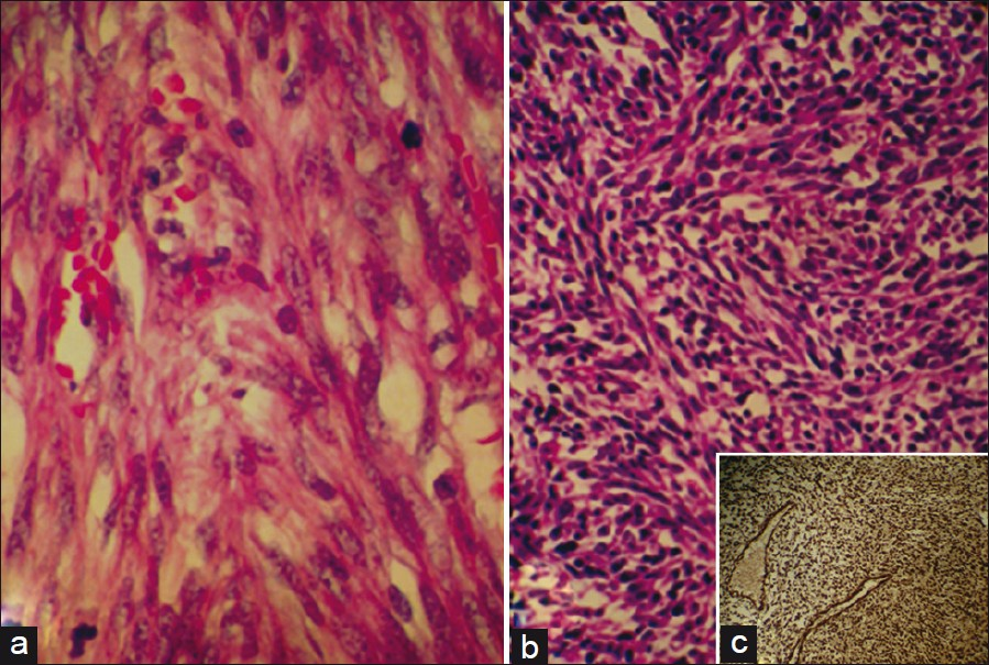 Histopathology (Hematoxylin and Eosin, X40). Case1. (a) The tumor shows a fascicular proliferation of spindle cells with eosinophilic cytoplasm, mild to moderate nuclear atypia and brisk mitotic activity (10 mitoses per 10 hpf). Case 2. (b) The tumor shows a nuclear pleomorphism and atypia and high mitotic activity (17 mitoses per hpf). (c) Immuno-stain demonstrates positive smooth muscle actin in the tumor cells.