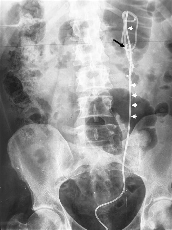 A plain X-ray film of the abdomen shows the original coiled JJ stent with formation of a complete knot (black arrow). An additional ureteral stent was inserted for rapid decompression of infected solitary kidney (white arrowhead).