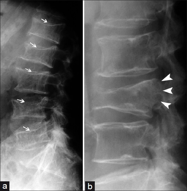 Usual benign vertebral compression (a) multiple levels, diffuse radiolucency, and whole vertebral endplate involvement (arrows); usual malignant vertebral compression characteristics (b) single vertebral involvement, focal and bulging of the posterior wall (arrowheads).