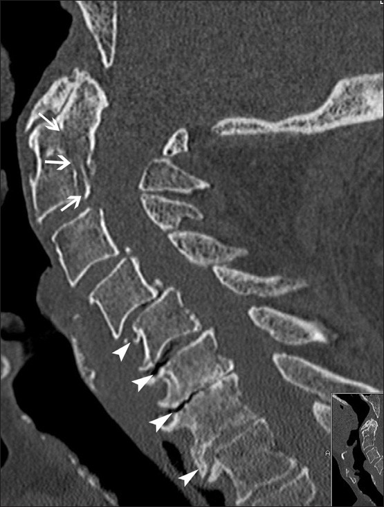 Missed fracture of the odontoid process and vertebral body of C2 (arrows) in a patient with a history of fall one month before. Note the associated degenerative changes of the lower cervical spine (arrowheads).