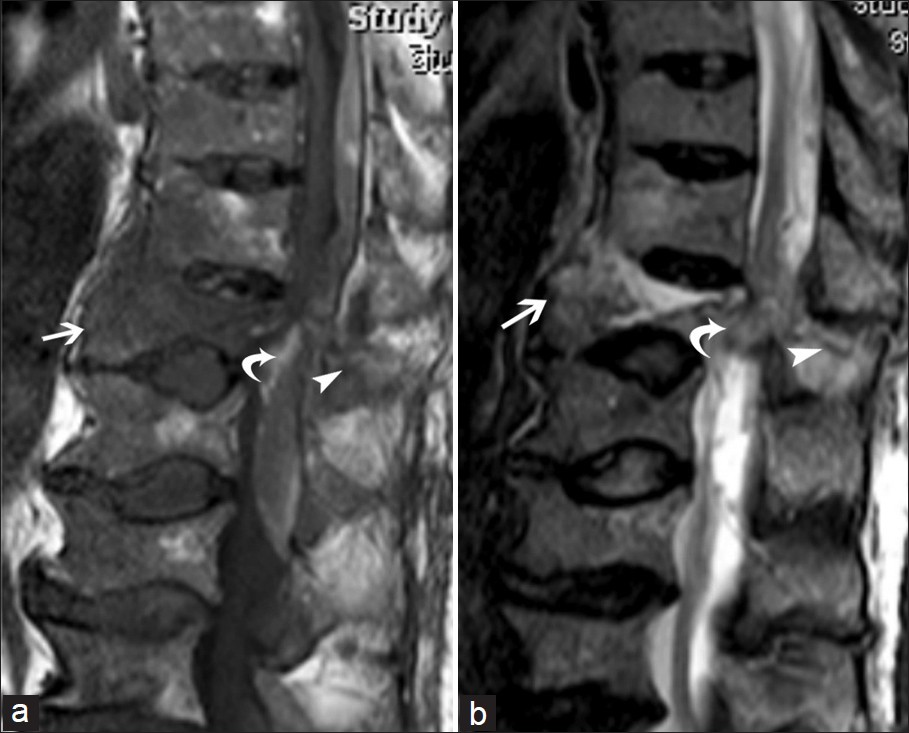 Transverse fracture of thoracic vertebral body (arrow) and posterior arch (arrowhead) with posterior epidural hematoma (curved arrow) in an ankylosed spine depicted on (a) T1- and (b) T2-weighted sequences.