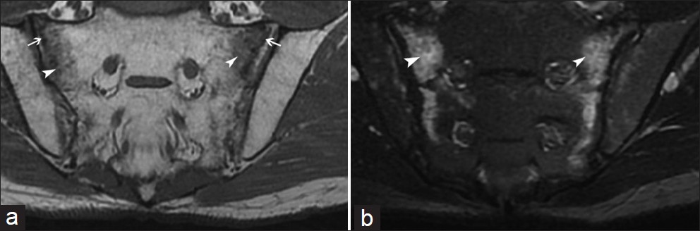 Insufficiency fractures (arrows) located in the sacrum with adjacent edema (arrowheads), better depicted on (a) T1- and (b) T2- weighted sequences, respectively. This bone edema should not be confused with sacroiliitis.