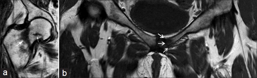 Multiple fractures (white arrows) in (a) the proximal femur and (b) pubic ramus on coronal T1-weighted images