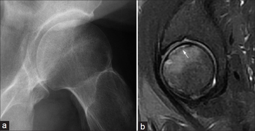 Subchondral fracture of the femoral head: (a) conventional radiography and (b) fat saturated sagittal T2-weighted image (white arrow).