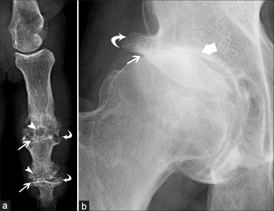 Typical osteoarthritis of (a) the distal and proximal interphalangeal joints and (b) hip joint: joint space narrowing (arrows), subchondral cysts (arrowheads), osteophytes (curved arrows), and subchondral sclerosis (thick arrow).