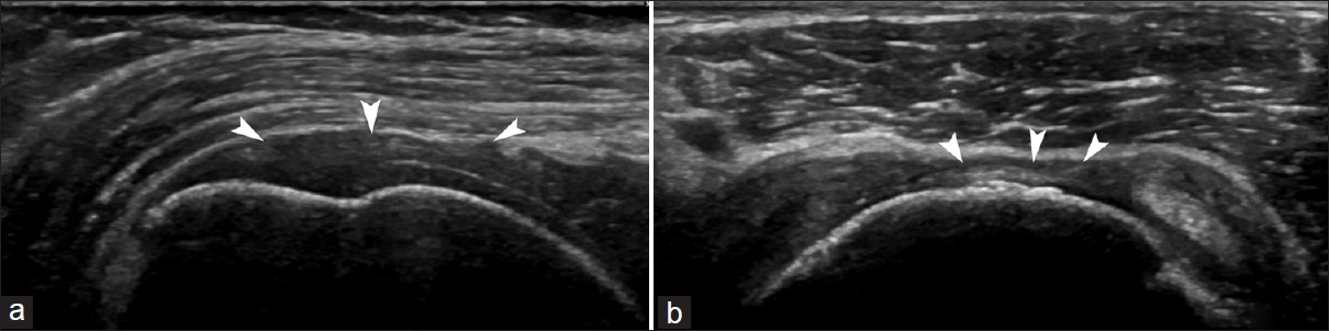 Ultrasound images in (a) the long and (b) short axis of the supraspinatus tendon demonstrating a complete tear (arrowheads).