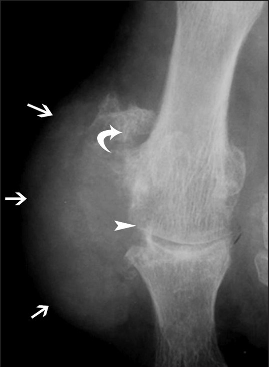 Gout of the first MTP joint in conventional radiography: Excentric dense nodular soft tissue mass (arrows), large erosions (arrowhead), lack of periarticular osteoporosis, and exuberant bony proliferation (curved arrow).