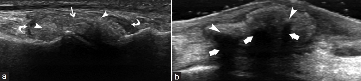 Gout involvement of the MTP (a) shows the tophus (arrow) with hyperechogenic microcrystal deposits (arrowheads) and a thickened synovium (curved arrows). Another patient with tophus deposition in the dorsal midfoot (b) demonstrates microcrystal deposits (arrowhead) with acoustic shadows (thick arrows).