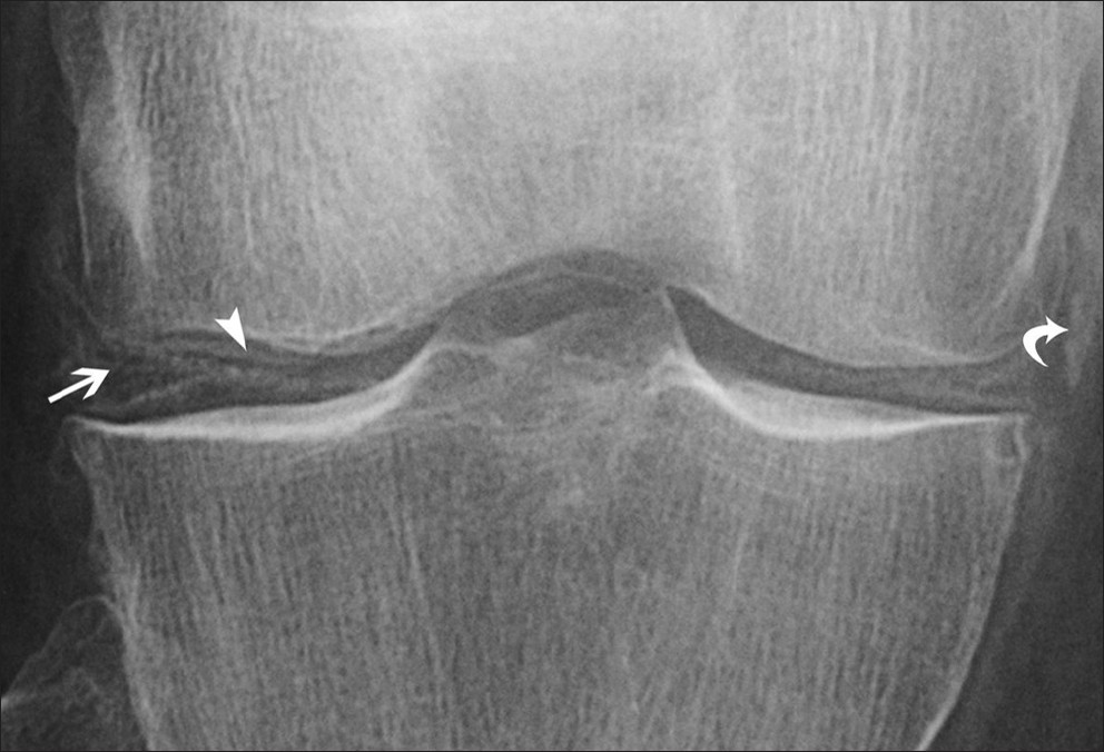 Calcium pyrophosphate dihydrate deposition disease demonstrated by deposits of microcrystals in the menisci (arrow), articular cartilage (arrowhead), and periarticular soft tissue (curved arrow).