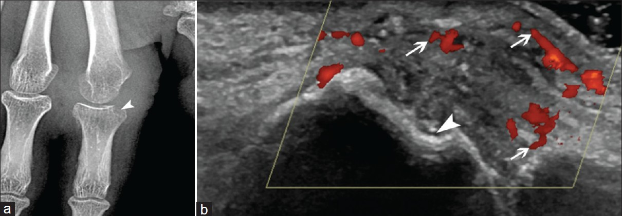 Tuberculosis of the second metacarpophalangeal joint. (a) On conventional radiography there is mild osteoporosis, extensive soft tissue swelling, and large marginal erosion (arrowhead), (b) On Doppler ultrasound the synovitis (arrows) and bone erosion (arrowhead) are well-depicted.