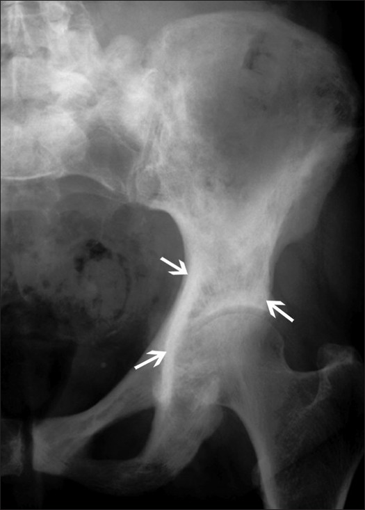 Paget's disease affecting the iliac bone demonstrated with coarsening of the bone trabeculae and cortical thickening (arrows).