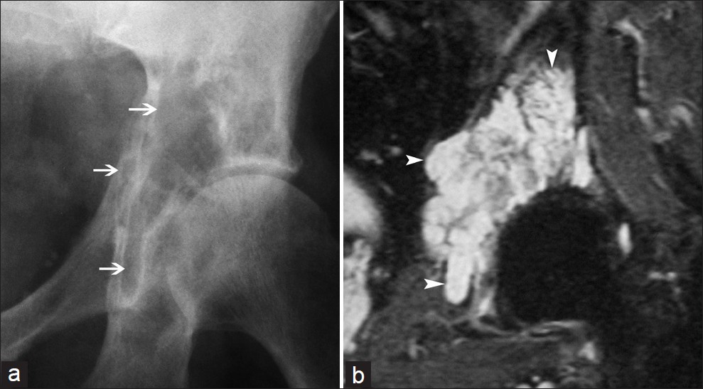 Chondrosarcoma of the pelvis in (a) conventional radiography appears as an isolated osteolytic lesion (arrows), (b) Coronal T2-weighted image demonstrates a lobulated hyperintense lesion (arrowheads).