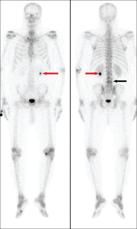 spect bone scan
