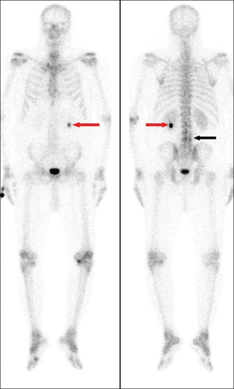 Whole body bone scan with 99Tc MDP of the patient. (a) Anterior and (b) posterior views, showing mildly increased tracer uptake in the lumbar vertebrae (black arrow) and intense, focal localization of the tracer in the lower pole of left kidney (red arrows).