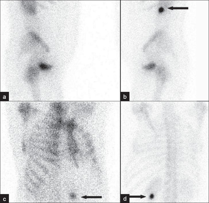 (a-b) Lateral and (c-d) oblique views clearly demonstrate the focal tracer uptake outside the skeletal structures in left kidney (arrows).