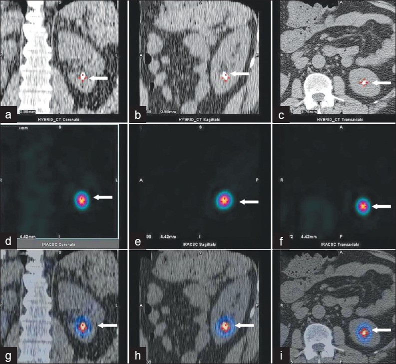 (a) Coronal, (b) sagittal and (c) transaxial CT images; (d) coronal (e) sagittal and (f) transaxial SPECT images; (g) Coronal, (h) sagittal and (i) transaxial SPECT-CT images. These revealed focal tracer accumulation in the left renal calculus (white arrows). The calculus measured 8 × 8 mm in size. The CT attenuation factor was 1060 Hounsfield unit, compatible with that of a renal calculus.