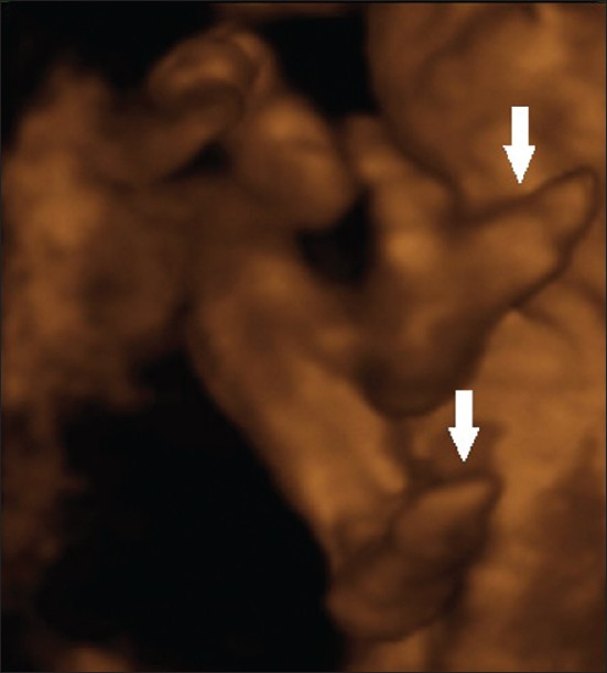 EEC syndrome. Three-dimensional ultrasound in rendering mode demonstrates the lobster-claw feet (white arrows).