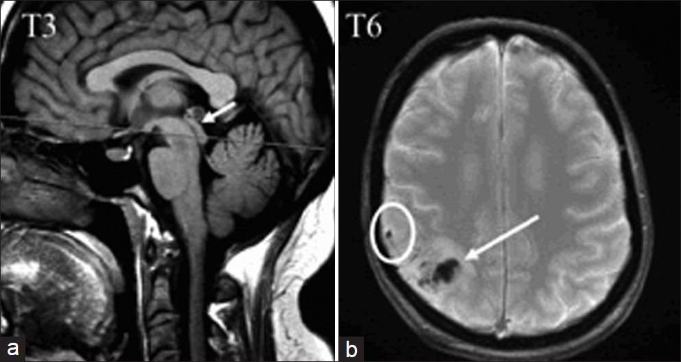 In patient T3, a sagittal T1 view shows the aqueductal stenosis (arrow), probably secondary to the diffusion of hemorrhage in the ventricular space. In patient T6, an axial T2* image shows the parietal cortical vein thrombosis (in a circle), and cortical venous infarct (arrow).