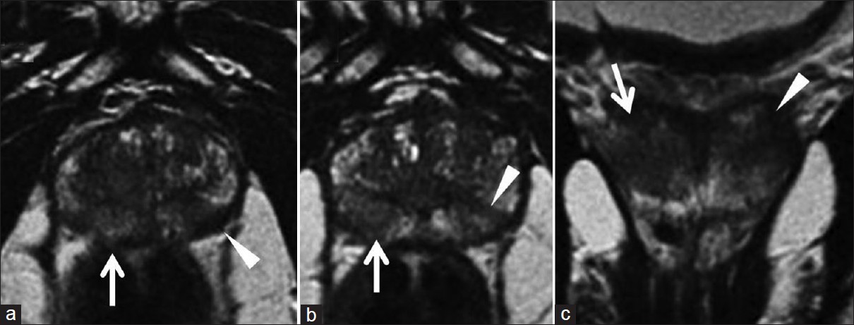 MRI T2-weighted images in (a, b) axial and (c) coronal views show two areas of altered signal, with oval-like morphology and hypointensity, respectively, localized in the peripheral region of the right (white arrow) and the left gland (white arrowhead).