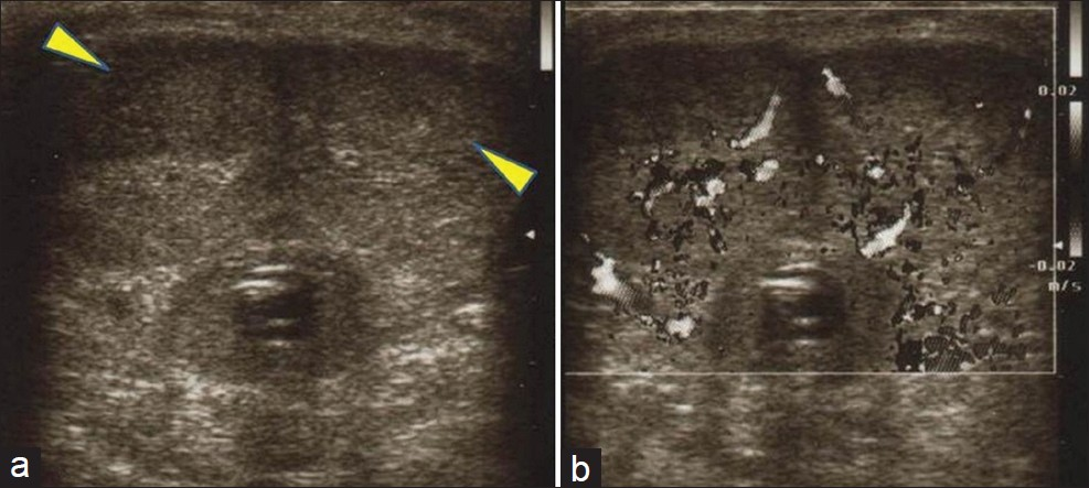 Gray-scale ultrasound images (a, b) show hypoechoic areas (yellow arrowhead), with intra-lesional vascularization on color flow Doppler examination, near the dorsal surface of the both corpora cavernosa.