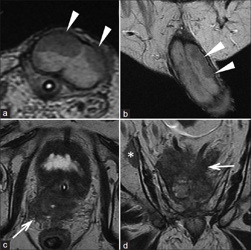 The T2-weighted images (a: axial and b: coronal) show the presence of nodules adherent to both cavernous bodies (white arrowheads). The T2- weighted images (c) and (d) show the loss of the normal architecture of the prostate due to solid tissue (recurrence of disease) which invades the region of the seminal vesicles and infiltrates the mesorectum (white arrows). Image (d) shows a bone metastasis (asterisk).