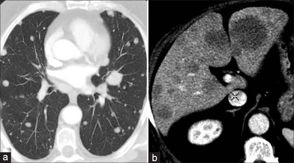 CT images through the (a) lung and (b) liver demonstrate multiple metastatic lesions.