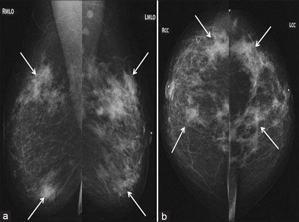 Bilateral diagnostic mammogram with (a) MLO and (b) CC views demonstrates new spiculated masses throughout both breasts (arrows) which were all initially suspicious for carcinoma.