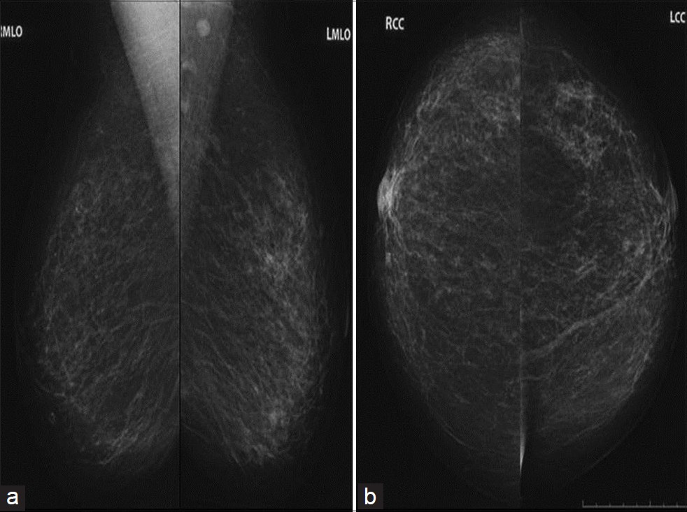 Comparison mammogram (a) MLO and (b) CC views 1 year prior shows only normal scattered fibroglandular breast tissue with no abnormal masses present.