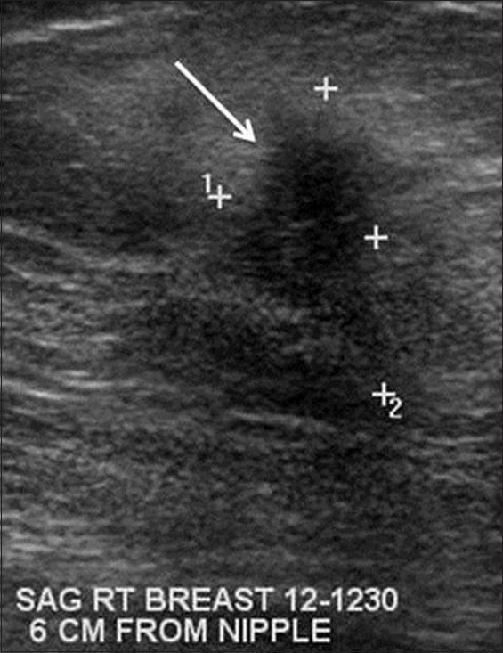 Gray-scale sonograhic image of the right breast demonstrates an irregular hypoechoic mass with angular margins (arrow). Similar masses were present in the bilateral breasts at nearly every clock position by ultrasound. This mass was biopsy proven to be sarcoidosis.