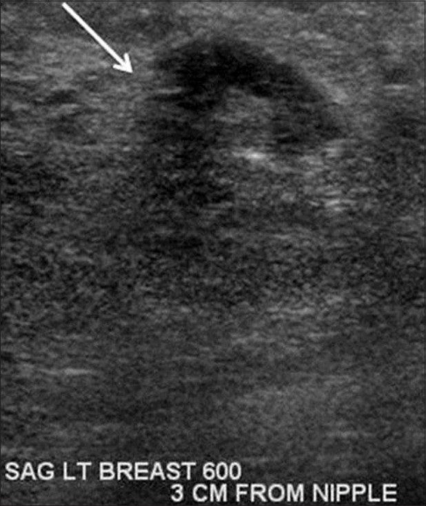 Gray-scale sonographic image of the left breast at the 6:00 o’clock position at the site of known lobular carcinoma also demonstrates an irregular hypoechoic mass (arrow).