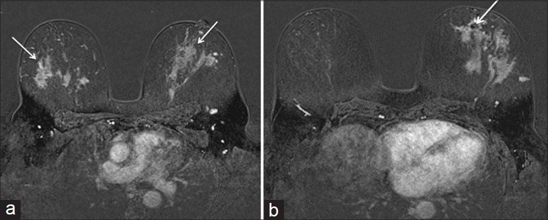 Axial MRI T1WI post contrast fat saturation subtracted images of the bilateral breasts (a) Breast sarcoidosis presents as multiple patchy bilateral areas of non-mass enhancement (arrows) (b) Known left breast lobular carcinoma at 6:00 o’clock position (arrow) with susceptibility artifact from biopsy clip is indistinguishable from the surrounding sarcoid lesions.